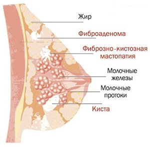 Диффузная фиброзно-кистозная мастопатия