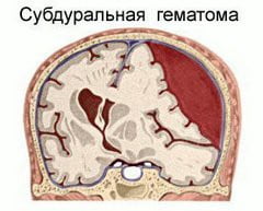 Субдуральная гематома
