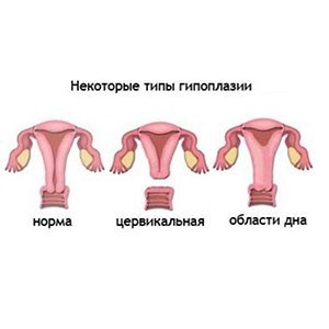 Типы гипоплазии матки