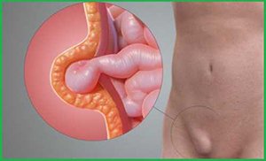 Грыжа прямой кишки у женщин
