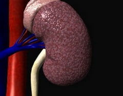 Инфаркт почки