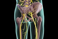 Боль - главный симптом ишиаса