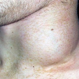 неходжкинская лимфома