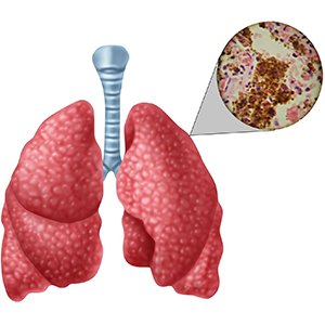 Открытая форма туберкулеза