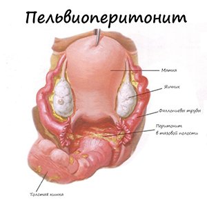 Пельвиоперитонит