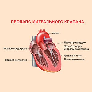 Пролапс митрального клапана 1 степени