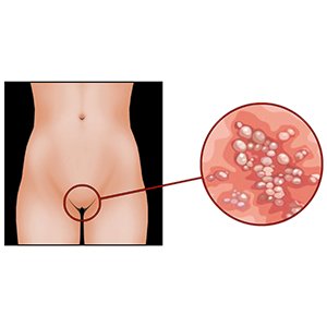 Сифилис у женщин